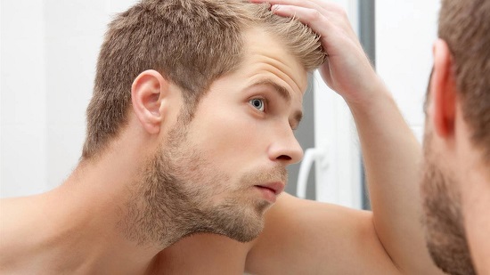 como combatir la calvicie como combatir la calvicie