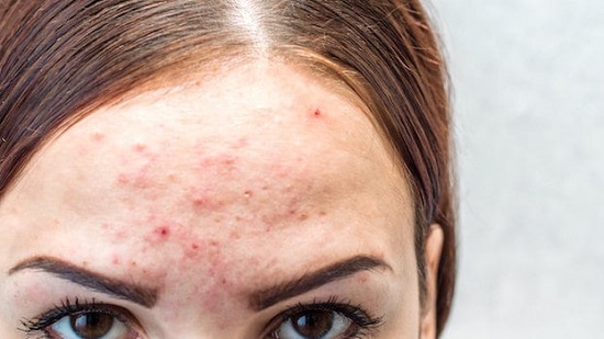 Consejos para el acné